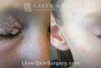 Full article: Laser thermal therapy of benign skin tumours: Review and ... How To Find Affordable Yet Stylish Clothing Options
